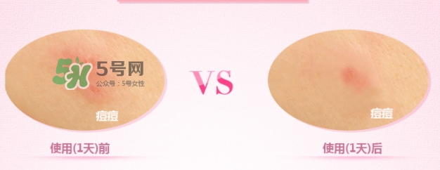 奧蓓斯痘痘貼怎么用？奧蓓斯痘痘貼貼多久？